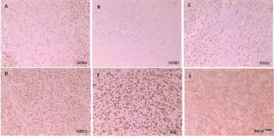 Metastatic Colorectal Cancer Patient With Microsatellite Stability and BRAFV600E Mutation Showed a Complete Metabolic Response to PD-1 Blockade and Bevacizumab: A Case Report